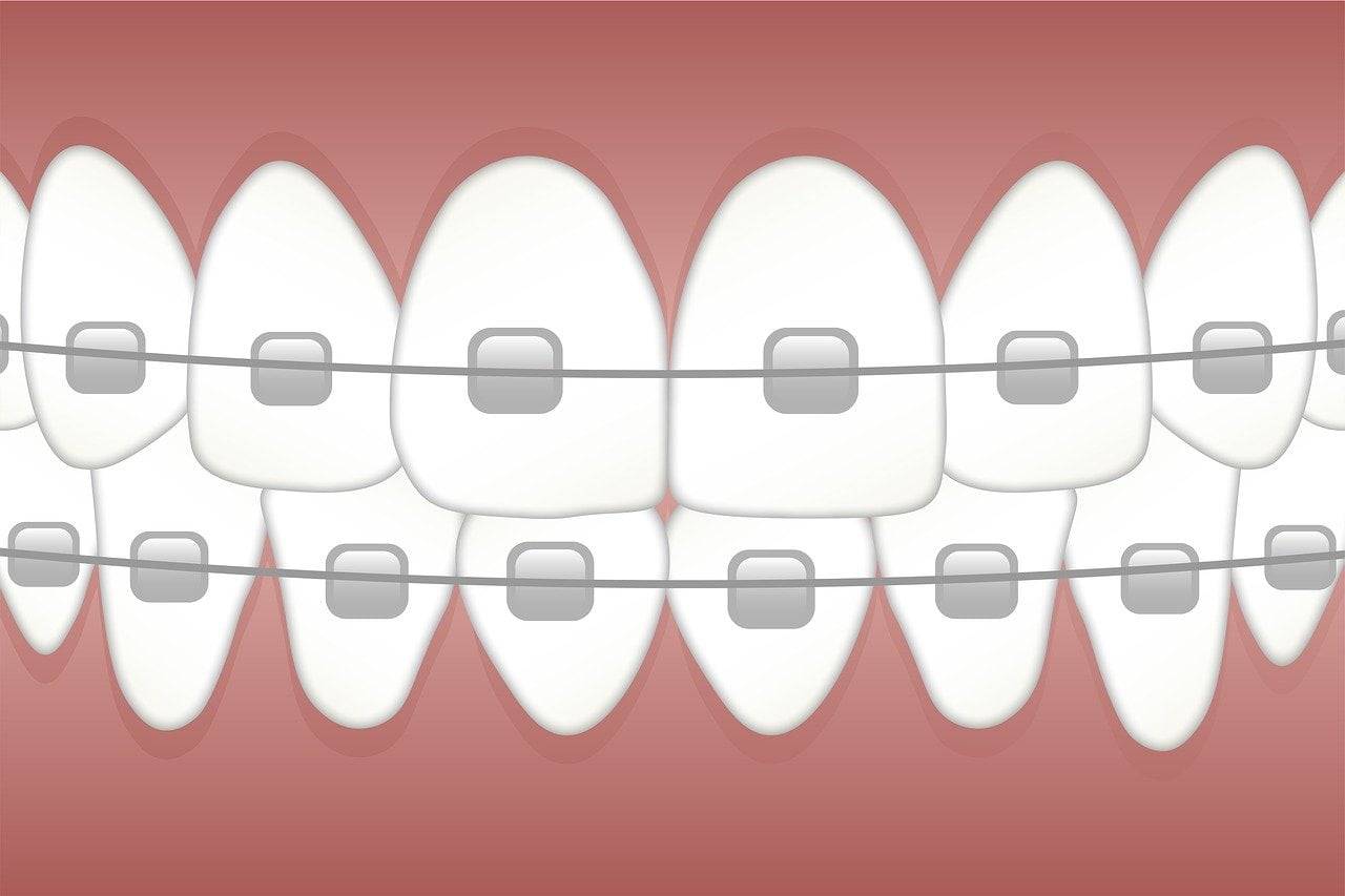 Diş Teli Uygulaması: Ağız ve Diş Sağlığı için Kullanımı