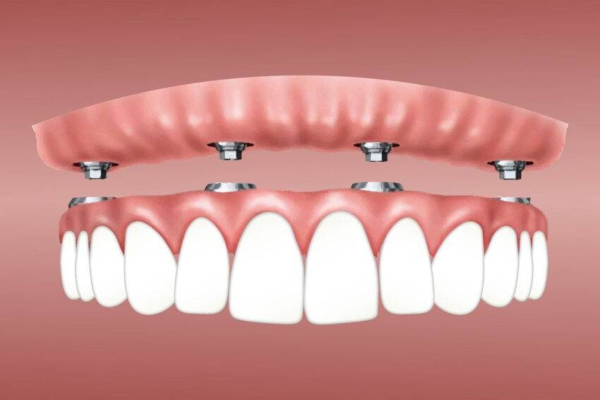 İmplant Tedavisi: Diş Kaybı ve Protez Uygulaması için Alternatif Bir Seçenek