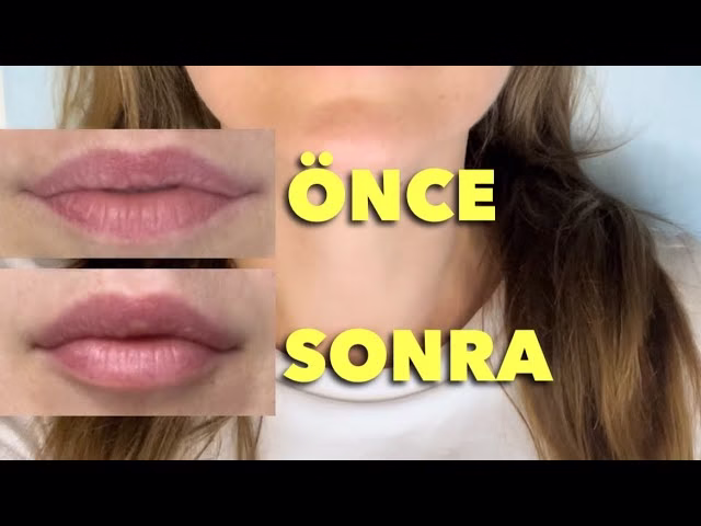 dudak_dolgusu_eritme_öncesi_sonrasi