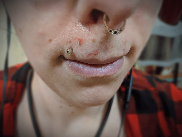 ağda_sonrası_bakım